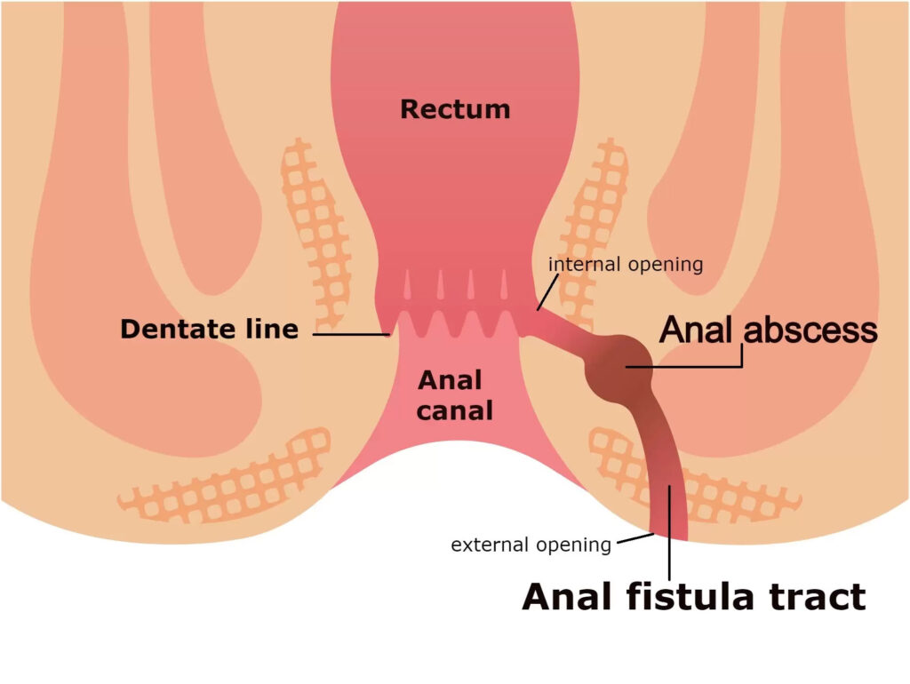FISTULA