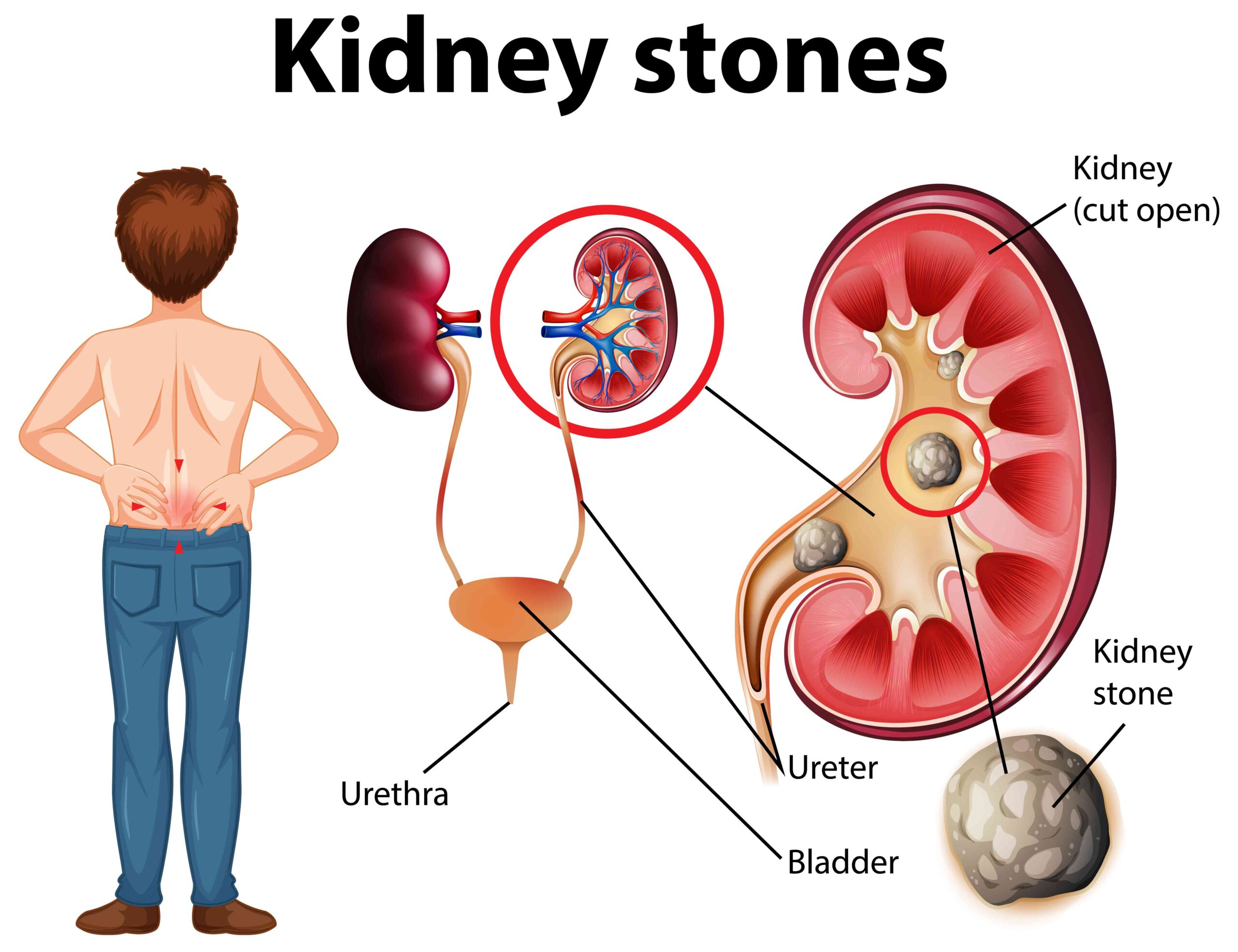 Kidney stones